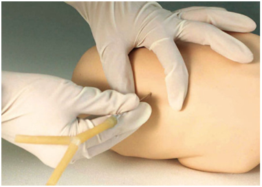 骨髓穿刺的適應癥